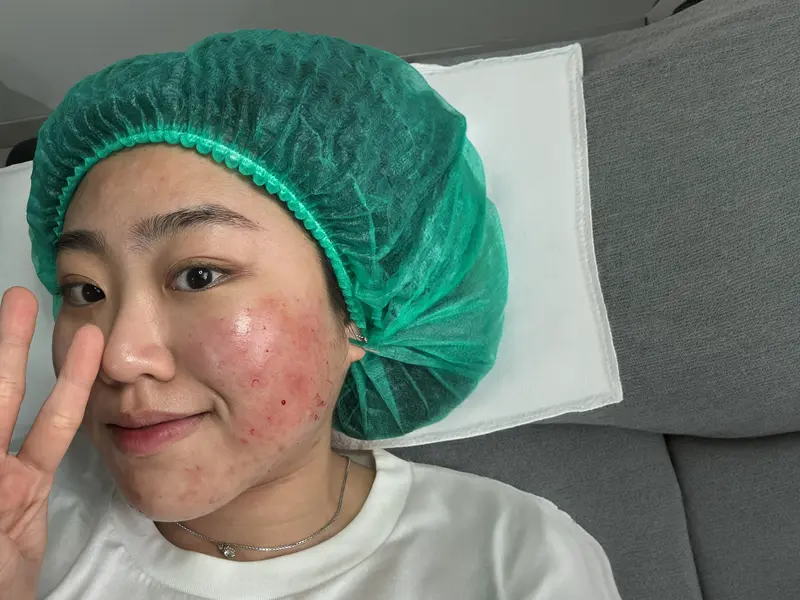 akupunktur kecantikan